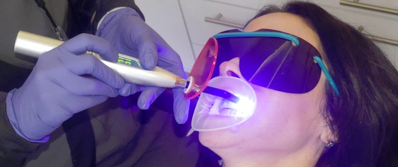 Teeth Whitening Archer Dental | View the VIBE Toronto